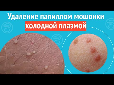 Видео: ✅ Удаление папиллом мошонки холодной плазмой. Клинический случай №1682