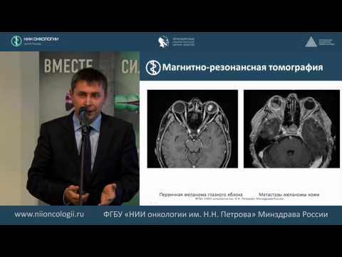 Видео: Возможности лучевых методов диагностики меланомы кожи