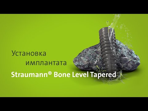Видео: Установка имплантата: Straumann® Bone Level Tapered