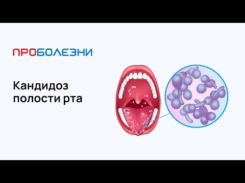 Видео: Кандидоз полости рта