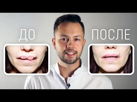 Видео: Как избавиться от филлера?