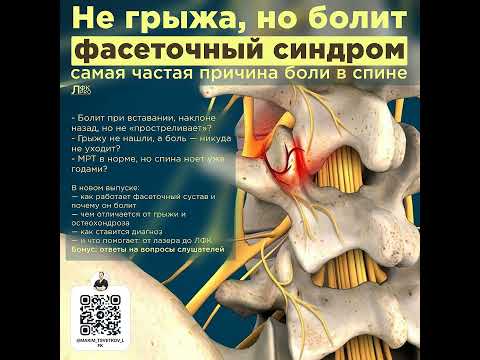 Видео: Не грыжа, но болит. Фасеточный болевой синдром