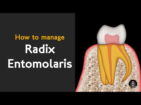 Видео: Radix entomolaris | Простая техника