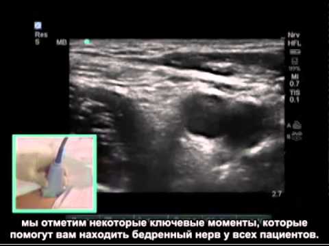 Видео: Порядок выполнения: блокада бедренного нерва под контролем ультразвуковой визуализации