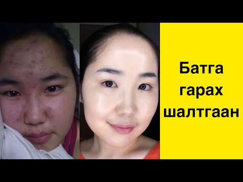 Видео: Causes Of Acne | Батга гарах шалтгаан