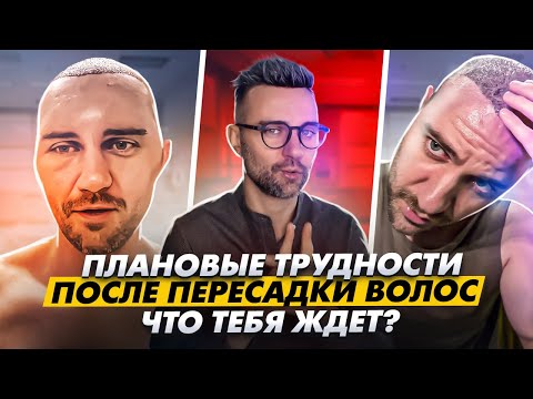 Видео: Типичные проблемы после пересадки волос: что тебя ждет? / KRASAV4IK