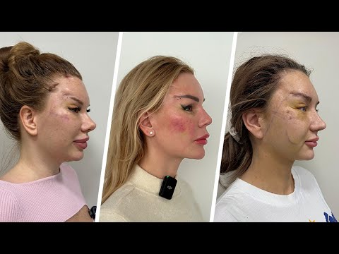 Видео: Эндоскопическая подтяжка средней трети лица и бровей в Турции: до и после