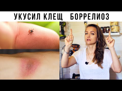 Видео: Как лечила Боррелиоз, болезнь Лайма. Симптомы, анализы, лечение.