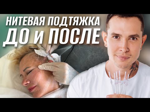 Видео: Подтяжка нитями ДО и ПОСЛЕ | Процесс установки нитей #мезонити