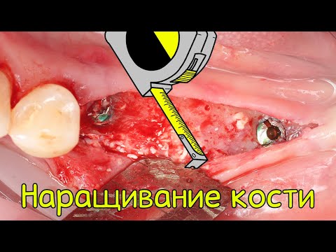 Видео: Что такое наращивание костной ткани? Результаты костной пластики с применением материала REGEGRAFT