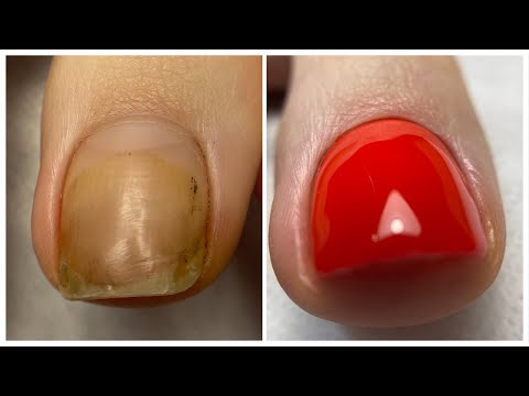 Видео: Комбинированный педикюр пальцев.Педикюр 2021.