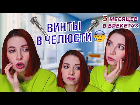 Видео: БРЕКЕТЫ UPDATE | УСТАНОВИЛИ ВИНТЫ В ЧЕЛЮСТЬ 😱 // Всё пошло не по плану...