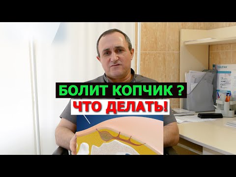 Видео: Киста копчика! Как вылечить.