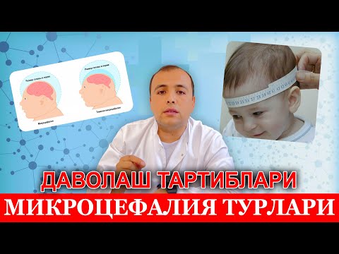 Видео: Микроцефалия касаллиги турлари ва уларни даволаш