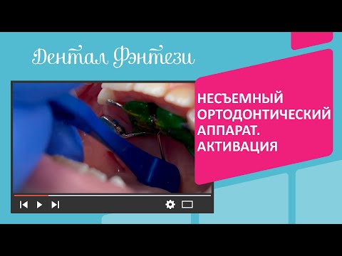 Видео: 🔎 Несъемный ортодонтический аппарат. Правила активации для родителей
