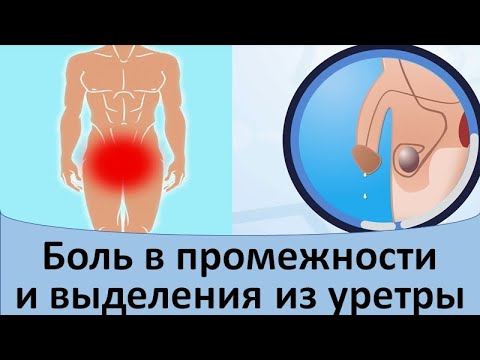 Видео: Боль в промежности и выделения из уретры у мужчин.