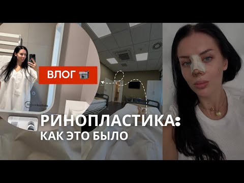 Видео: РИНОПЛАСТИКА.📍ВЛОГ// Реабилитация| Мой опыт. Vlog