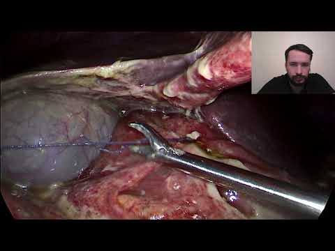 Видео: Перфорация язвы. Лапароскопическое ушивание. Peptic ulcer. Ls-suturing.