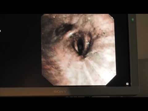 Видео: 01 Соколов СА Бронхоскопия, биопсия Рак легкого OLYMPUS