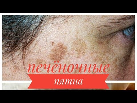 Видео: ПЕЧЕНОЧНЫЕ ПЯТНА. Как избавиться от пятен на коже?