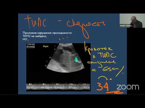 Видео: Ультразвуковое «сопровождение» больного циррозом печени