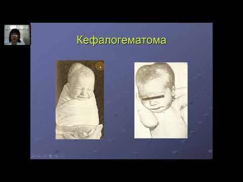 Видео: Бош мия тугрук травмалари