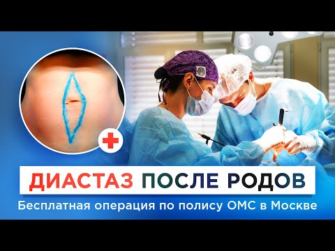 Видео: Как избавиться от диастаза после родов? Симптомы, причины, бесплатное лечение по ОМС
