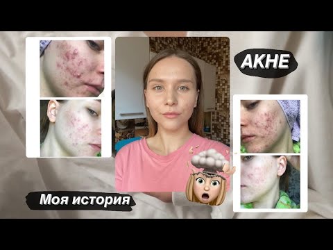 Видео: МОЯ ИСТОРИЯ ЛЕЧЕНИЯ АКНЕ / Рассуждаю на тему здоровой кожи + ФОТО моей кожи ДО/ПОСЛЕ