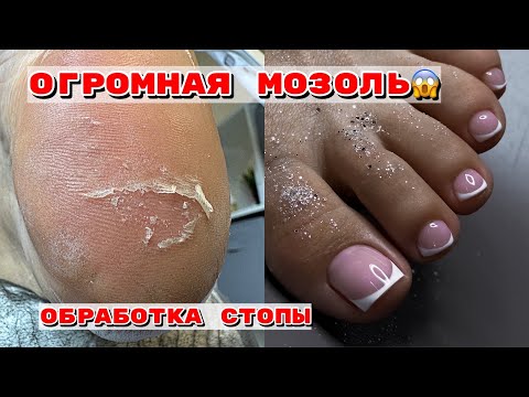 Видео: ОГРОМНАЯ мозоль😱на пятке/Педикюр френч😍