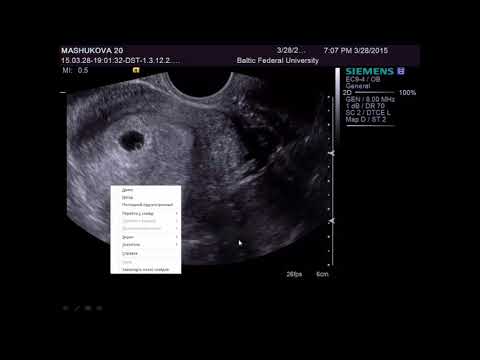 Видео: Ультразвуковая диагностика беременности. I триместр
