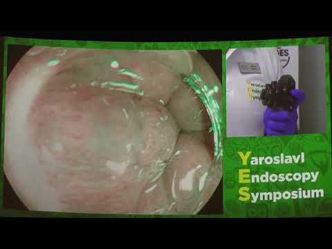 Видео: 15Live Rehan Haidry Пищевод Барретта Гибрдная аргоно плазменная коагуляция