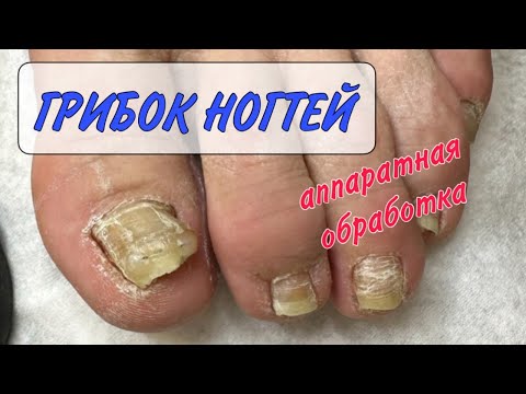 Видео: Медицинский педикюр/ грибок ногтей/ педикюр у подолога