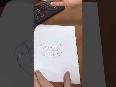 Видео: Разбор тимпанопластики с санирующим вмешательством