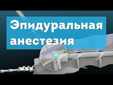 Видео: Эпидуральная анестезия. Epidural Anesthesia 3D