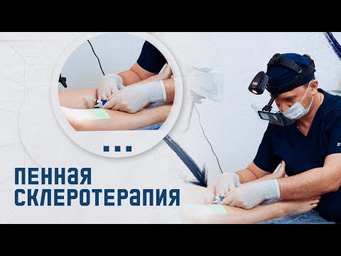 Видео: Пенная склеротерапия - просто и понятно. Рассказывает флеболог с большим стажем