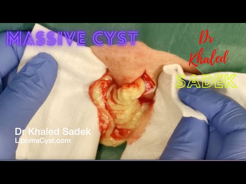 Видео: Удаление массивной кисты. Доктор Халед Садек. LipomaCyst.com