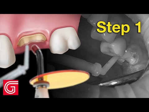 Видео: КАК НАРАЩИВАТЬ ЗУБ №14 ПРИ КАРИЕСЕ ДО ПРЕПАРАТИРОВАНИЯ