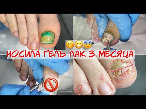 Видео: Пустота под ногтем 😮⚡Травма ногтя и онихолизис