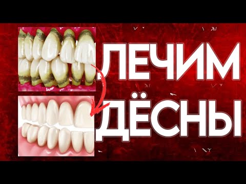 Видео: Лечим гингивит и пародонтит