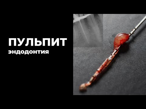 Видео: ПУЛЬПИТ ПРОТОКОЛ ЭНДОДОНТИЧЕСКОГО ЛЕЧЕНИЯ