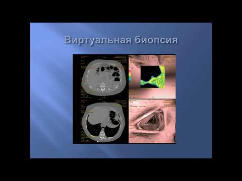 Видео: КТ виртуальная колонграфия