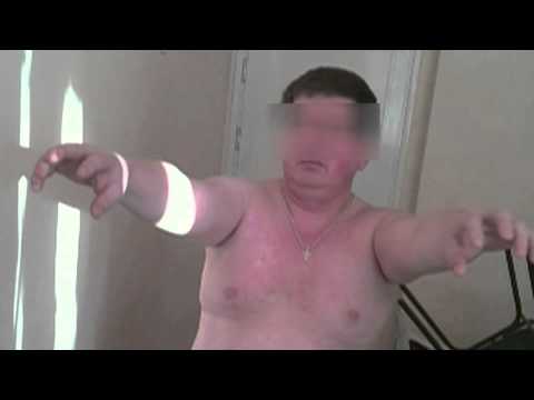 Видео: Миоклонус Фридрейха