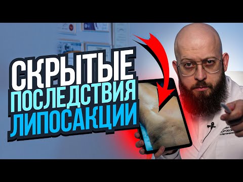 Видео: ВСЕ МОЛЧАТ ОБ ЭТИХ ПОСЛЕДСТВИЯХ ЛИПОСАКЦИИ. Какие бывают осложнения после липосакции