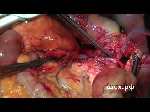 Видео: Гастрэктомия открытым доступом.