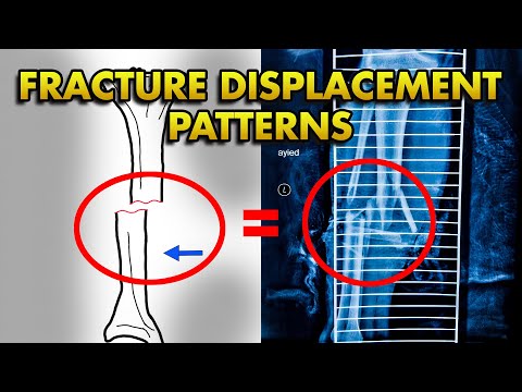 Видео: Подробное описание характера смещения переломов и их описание