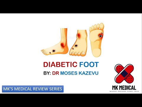Видео: Диабетическая стопа