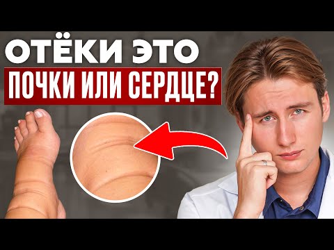 Видео: УЗНАЙ какой ОРГАН начал ОТКАЗЫВАТЬ по ОТЕКАМ! ТЕСТ за 60 секунд ДОМА