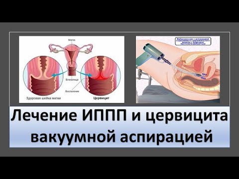 Видео: Лечение цервицита и ИППП вакуумной аспирацией