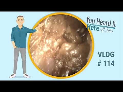 Видео: Кошмар от ушной серы: 20-минутное удаление ушной серы с помощью ушного ёршика | Видеоблог доктора...