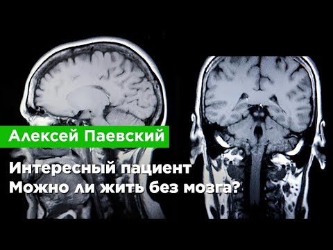Видео: Алексей Паевский — Интересный пациент. Можно ли жить без мозга?